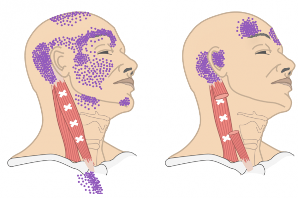 cervicogene hoofdpijn