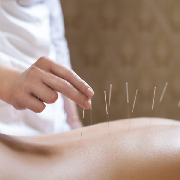 acupunctuur_antwerpen_berchem